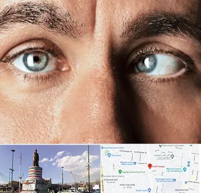 فوق تخصص استرابیسم در کارگر جنوبی 