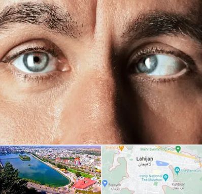 فوق تخصص استرابیسم در لاهیجان