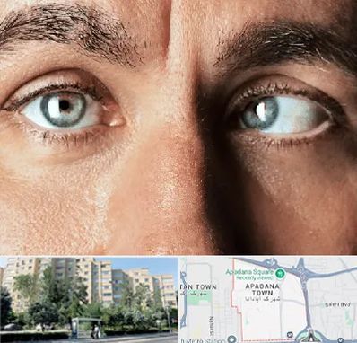 فوق تخصص استرابیسم در آپادانا