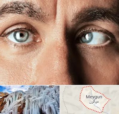 فوق تخصص استرابیسم در میگون