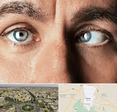 فوق تخصص استرابیسم در قزوین