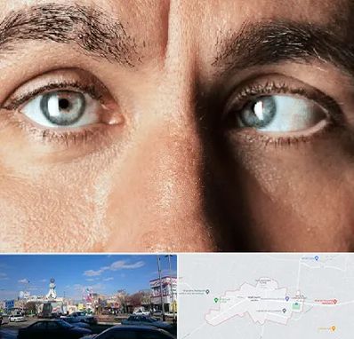 فوق تخصص استرابیسم در ماهدشت کرج 