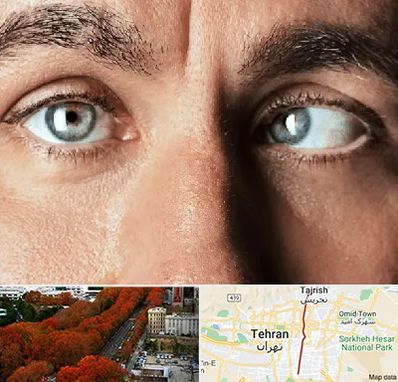 فوق تخصص استرابیسم در ولیعصر 