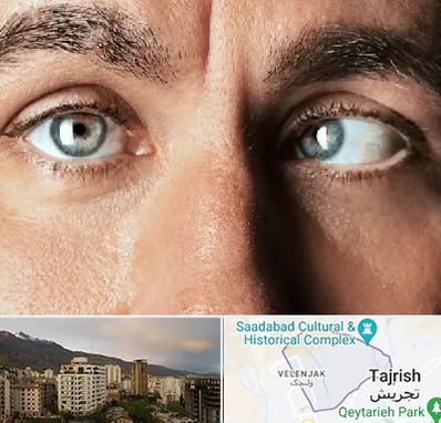 فوق تخصص استرابیسم در زعفرانیه 