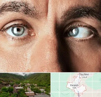 فوق تخصص استرابیسم در کلاله