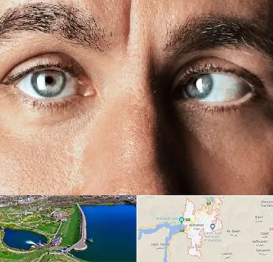 فوق تخصص استرابیسم در مهاباد