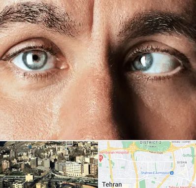 فوق تخصص استرابیسم در مرزداران 