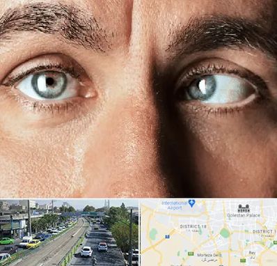 فوق تخصص استرابیسم در جنوب تهران 