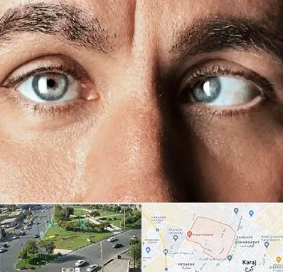 فوق تخصص استرابیسم در شاهین ویلا کرج