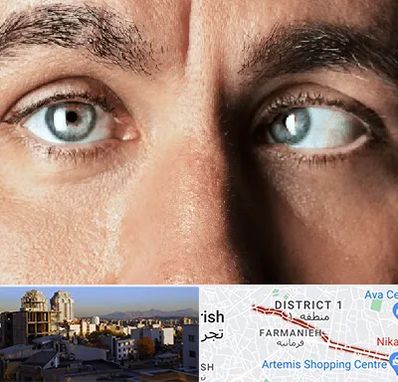 فوق تخصص استرابیسم در فرمانیه 