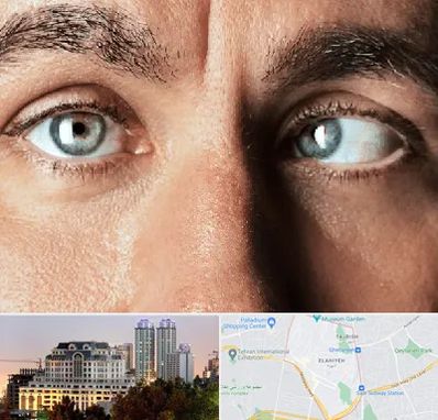 فوق تخصص استرابیسم در فرشته 