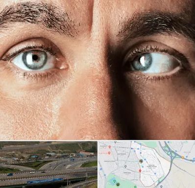 فوق تخصص استرابیسم در یاغچیان تبریز