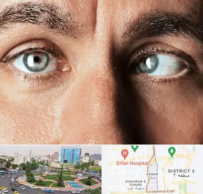 فوق تخصص استرابیسم در ونک 