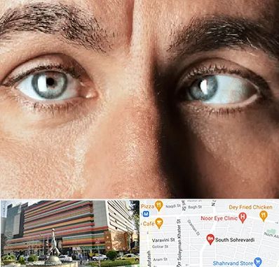 فوق تخصص استرابیسم در سهروردی 