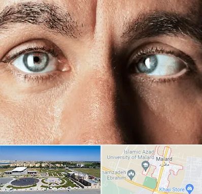 فوق تخصص استرابیسم در ملارد