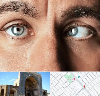 فوق تخصص استرابیسم در مصلی مشهد