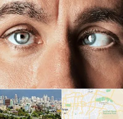 فوق تخصص استرابیسم در شرق تهران 