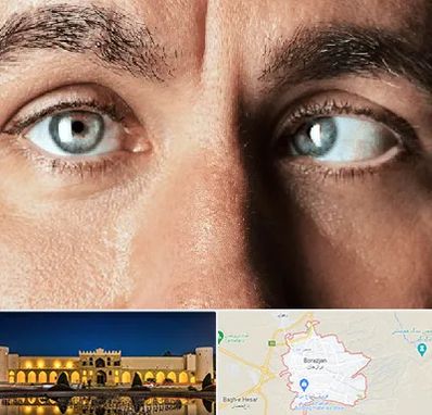 فوق تخصص استرابیسم در برازجان