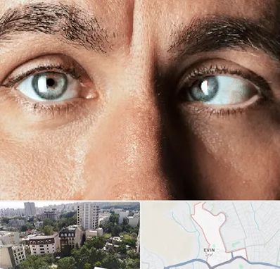 فوق تخصص استرابیسم در اوین