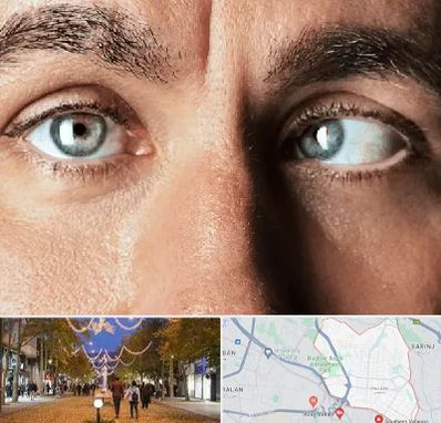 فوق تخصص استرابیسم در ولیعصر ارومیه