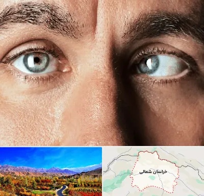 فوق تخصص استرابیسم در خراسان شمالی