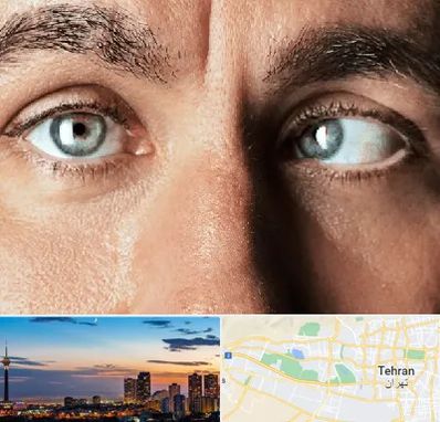 فوق تخصص استرابیسم در غرب تهران 