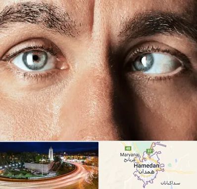 فوق تخصص استرابیسم در همدان