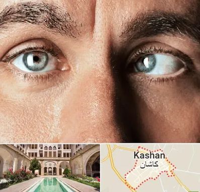 فوق تخصص استرابیسم در کاشان