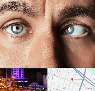 فوق تخصص استرابیسم در آبرسان تبریز