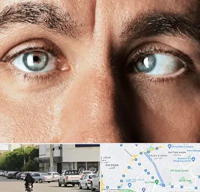 فوق تخصص استرابیسم در قدوسی شرقی شیراز