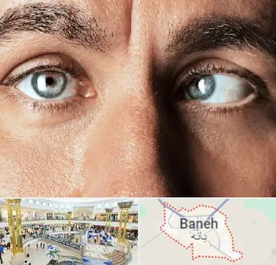 فوق تخصص استرابیسم در بانه