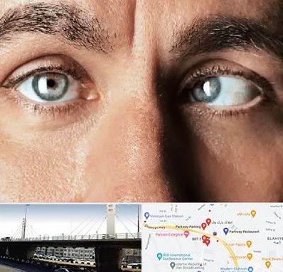 فوق تخصص استرابیسم در پارک وی 