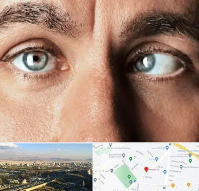 فوق تخصص استرابیسم در هنگام 