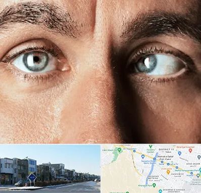 فوق تخصص استرابیسم در شریعتی مشهد