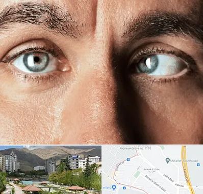 فوق تخصص استرابیسم در شهر زیبا 