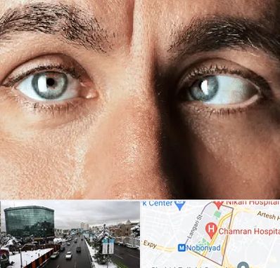 فوق تخصص استرابیسم در اقدسیه 