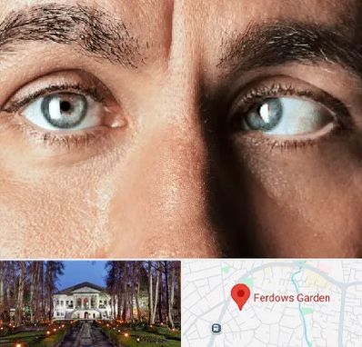 فوق تخصص استرابیسم در باغ فردوس