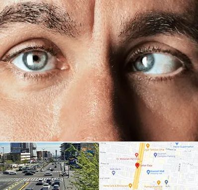 فوق تخصص استرابیسم در ستاری 