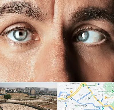 فوق تخصص استرابیسم در کوی وحدت شیراز