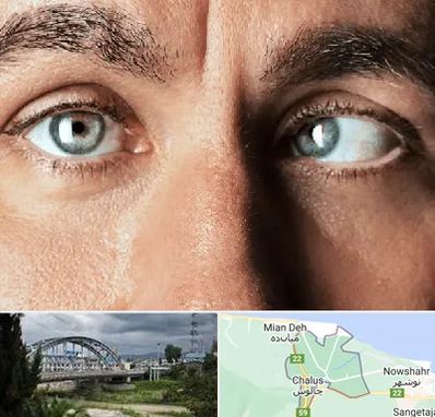 فوق تخصص استرابیسم در چالوس