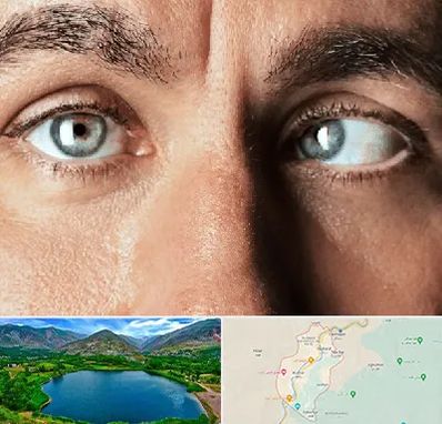 فوق تخصص استرابیسم در رودبار