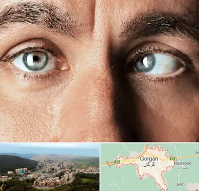 فوق تخصص استرابیسم در گرگان