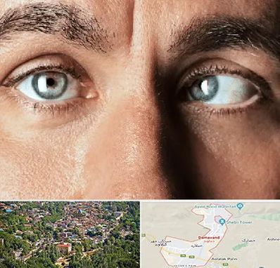 فوق تخصص استرابیسم در دماوند