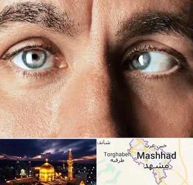 فوق تخصص استرابیسم در مشهد