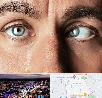 فوق تخصص استرابیسم در گلسار رشت 