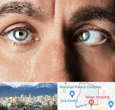 فوق تخصص استرابیسم در آجودانیه 