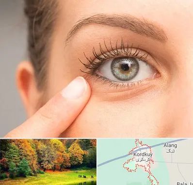 جراح پف چشم در کردکوی
