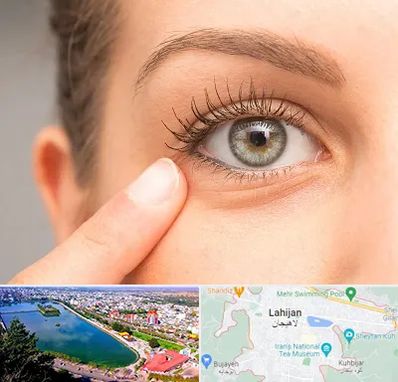 جراح پف چشم در لاهیجان