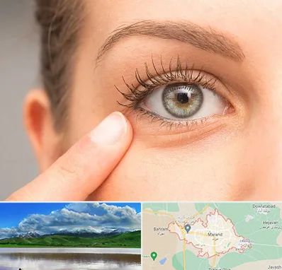 جراح پف چشم در مرند