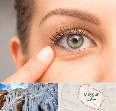 جراح پف چشم در میگون